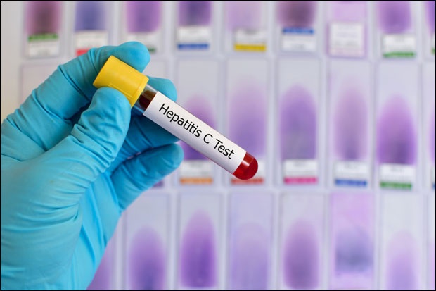 hepatitis